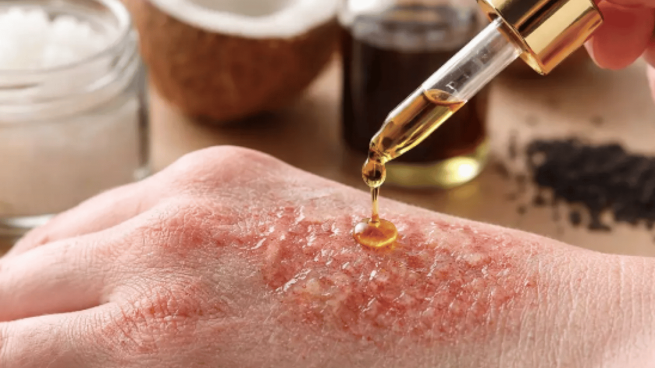 Foto - Egzamayı 3 günde bitiriyor! 1 damlasını karıştırın, sürün