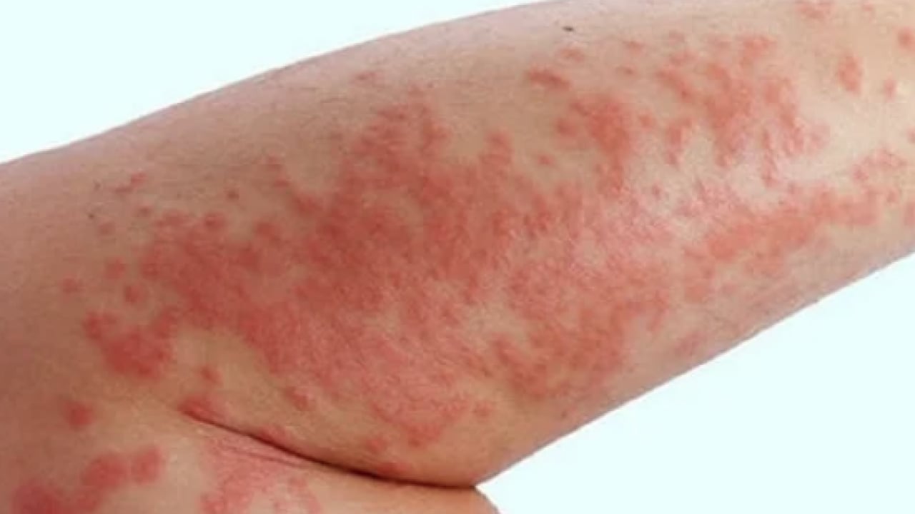 Foto - Egzamayı 3 günde bitiriyor! 1 damlasını karıştırın, sürün