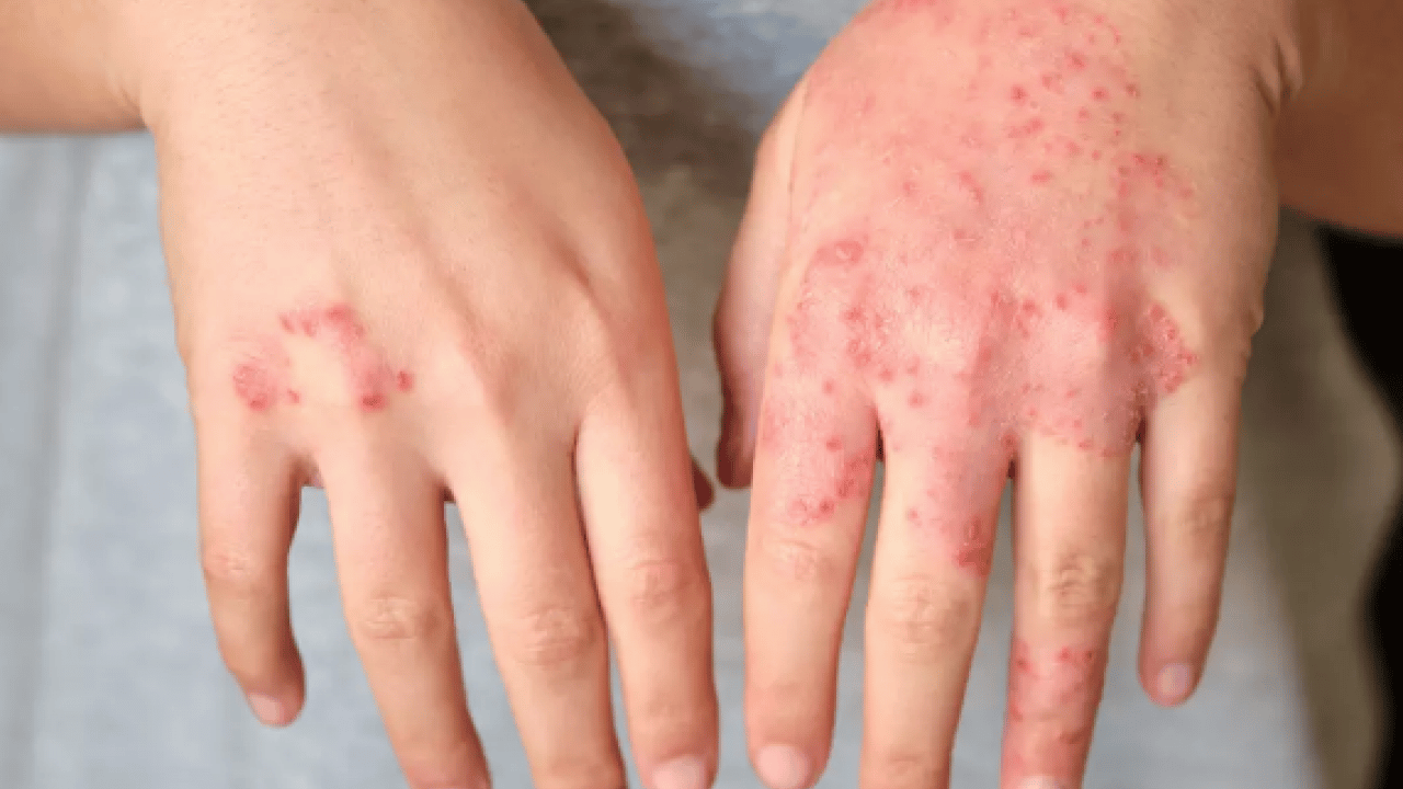 Foto - Egzamayı 3 günde bitiriyor! 1 damlasını karıştırın, sürün