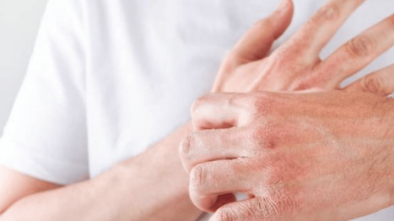 Egzamayı 3 günde bitiriyor! 1 damlasını karıştırın, sürün