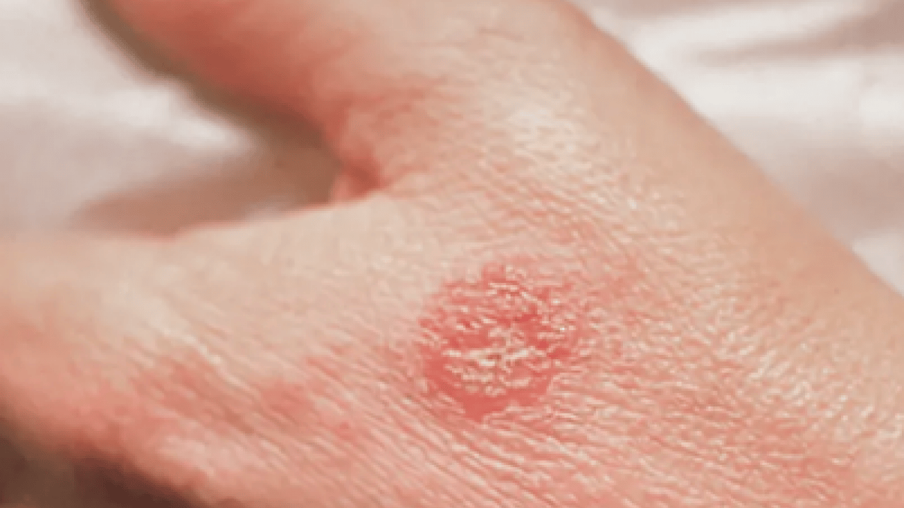 Foto - Egzamayı 3 günde bitiriyor! 1 damlasını karıştırın, sürün