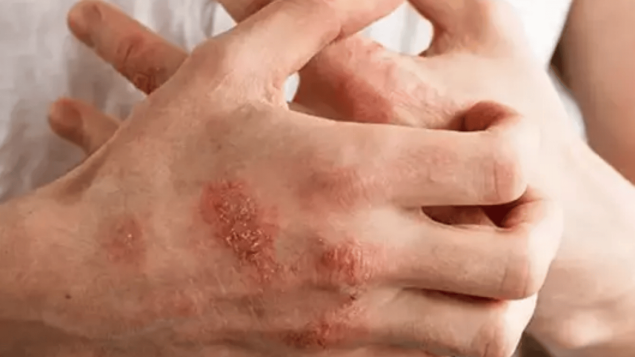 Foto - Egzamayı 3 günde bitiriyor! 1 damlasını karıştırın, sürün