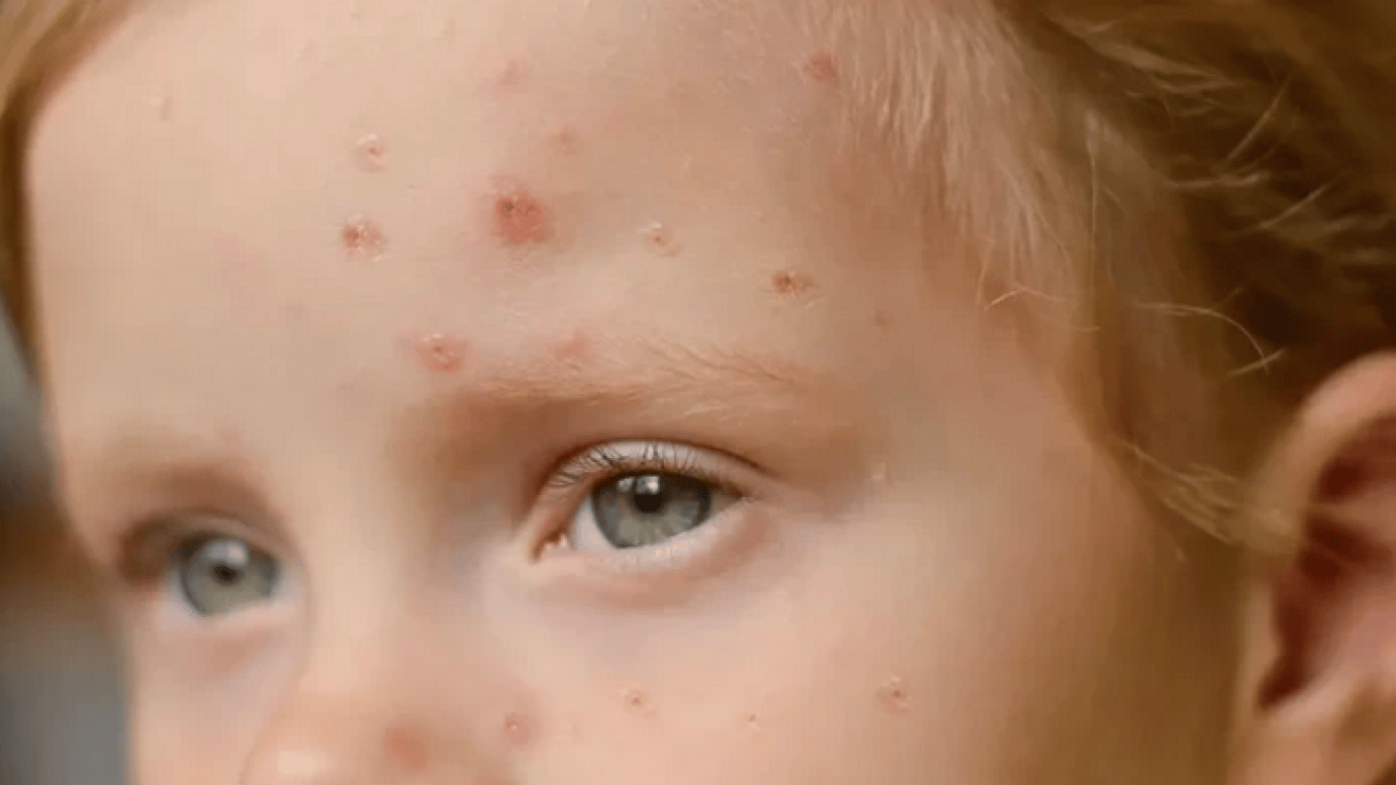 Foto - Su çiçeği virüsü yıllar sonra neden uyanıyor? Ortaya çıkan bir enfeksiyon ve...