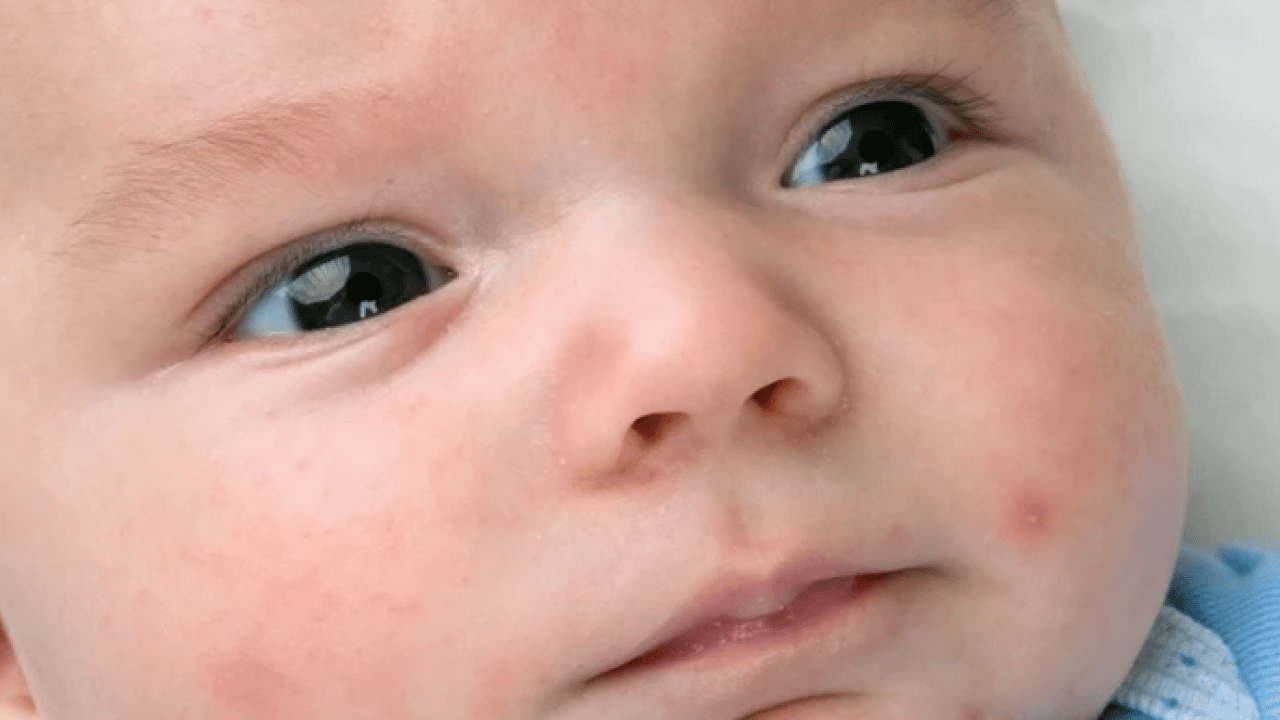 Foto - Su çiçeği virüsü yıllar sonra neden uyanıyor? Ortaya çıkan bir enfeksiyon ve...