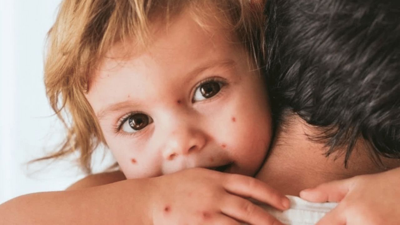 Foto - Su çiçeği virüsü yıllar sonra neden uyanıyor? Ortaya çıkan bir enfeksiyon ve...