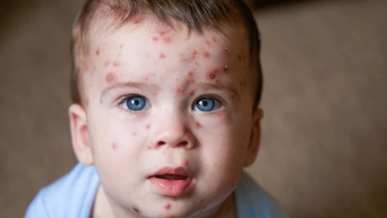 Foto - Su çiçeği virüsü yıllar sonra neden uyanıyor? Ortaya çıkan bir enfeksiyon ve...