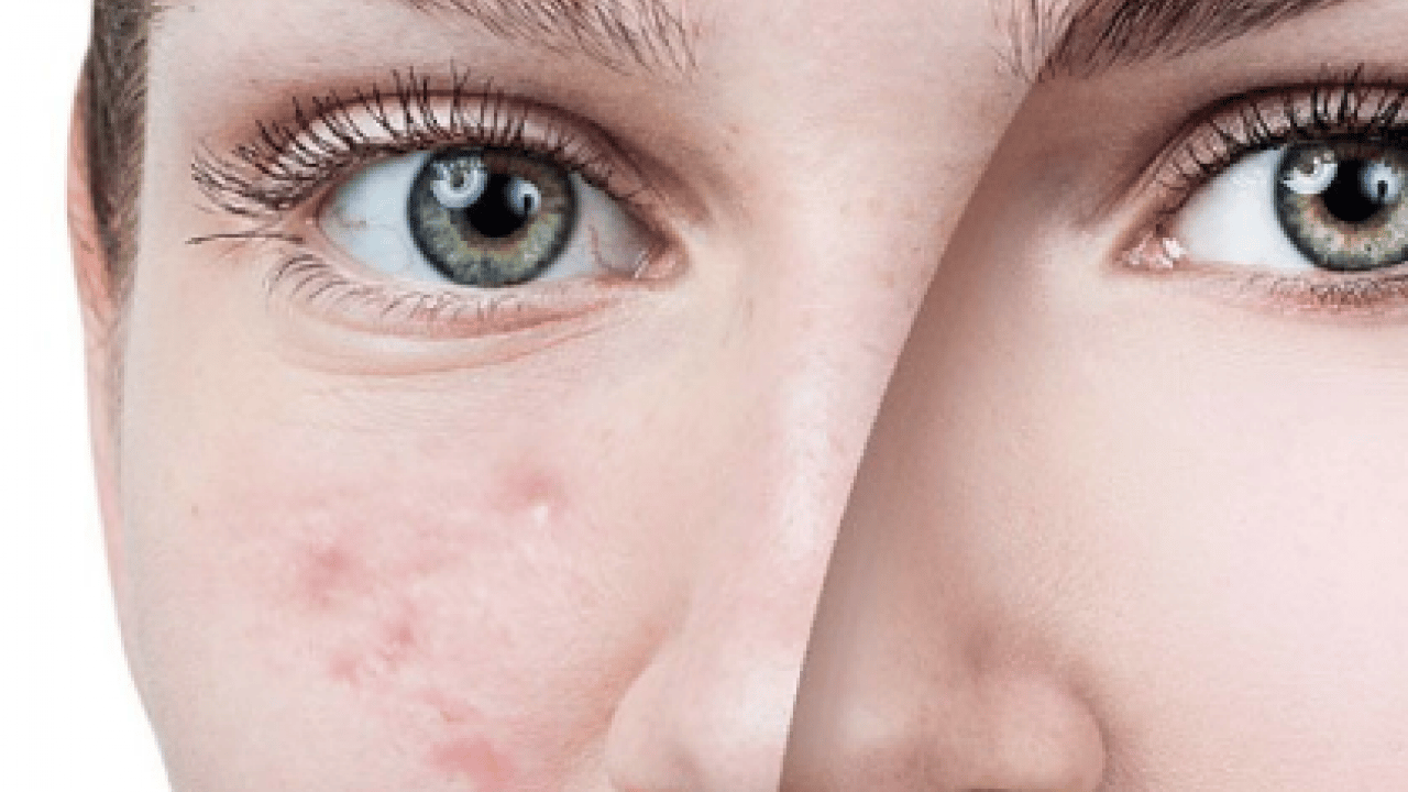 Foto - Tam bir çözüm metodu: Sivilce izlerini tek gecede siliyor! Aktarlarda kapış kapış satılıyor...