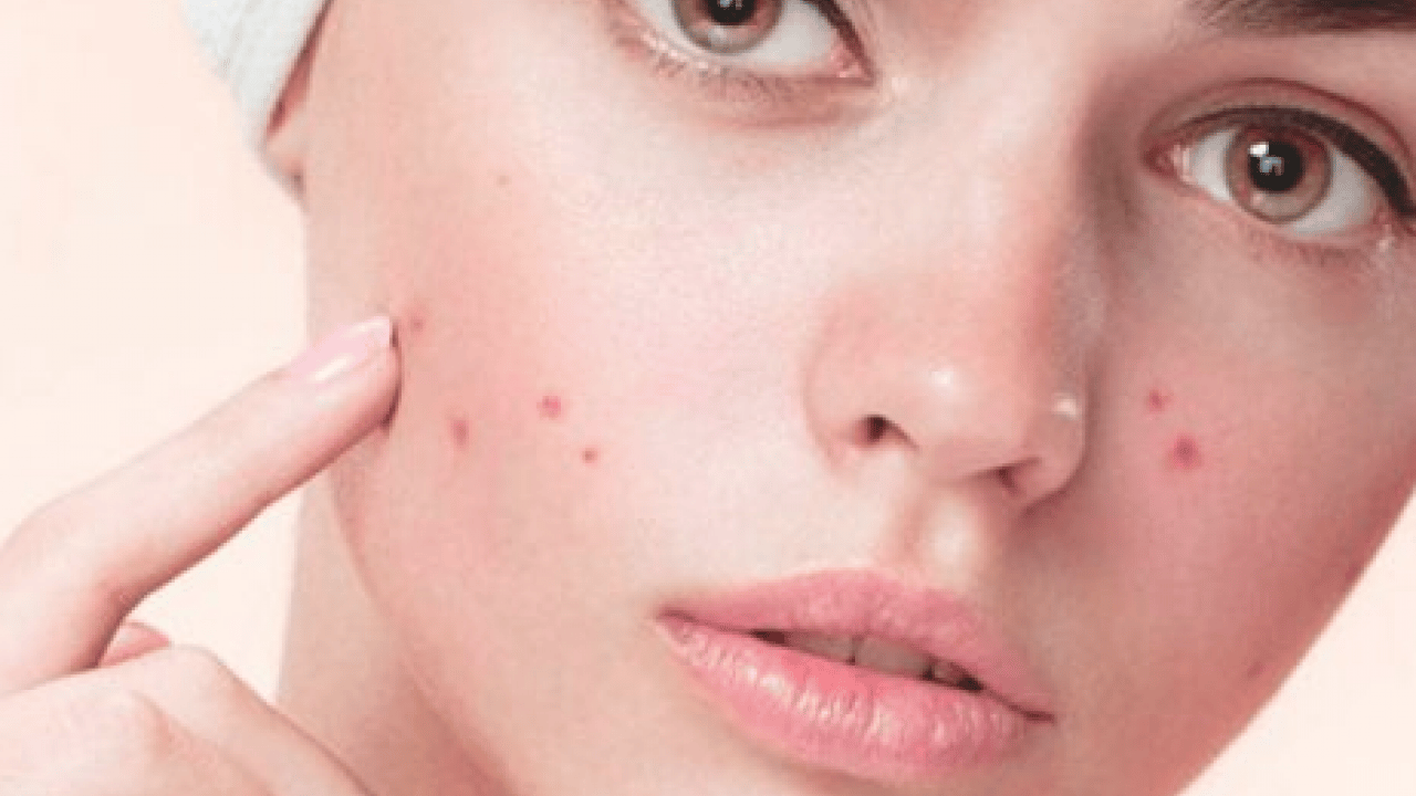 Foto - Tam bir çözüm metodu: Sivilce izlerini tek gecede siliyor! Aktarlarda kapış kapış satılıyor...