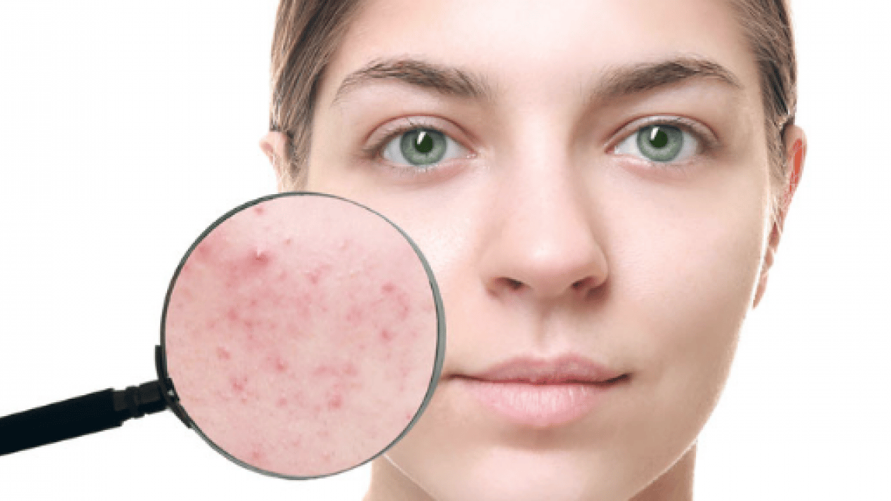 Foto - Tam bir çözüm metodu: Sivilce izlerini tek gecede siliyor! Aktarlarda kapış kapış satılıyor...