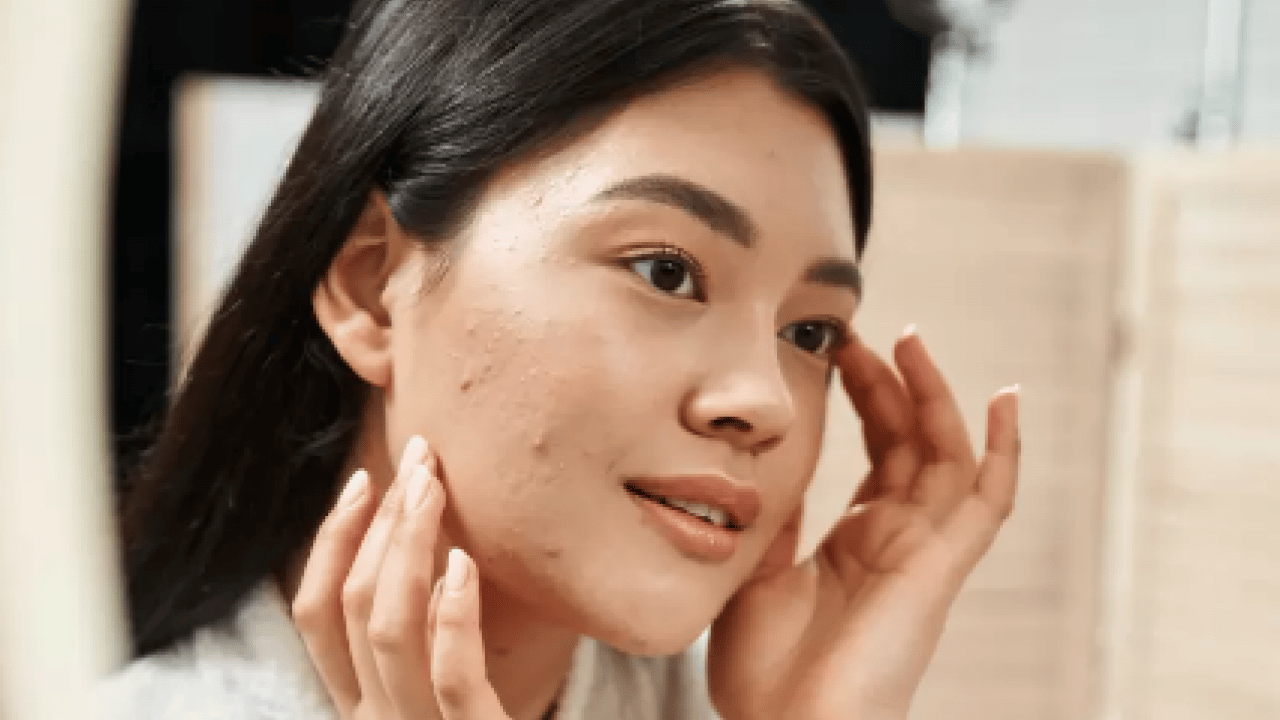 Foto - Tam bir çözüm metodu: Sivilce izlerini tek gecede siliyor! Aktarlarda kapış kapış satılıyor...