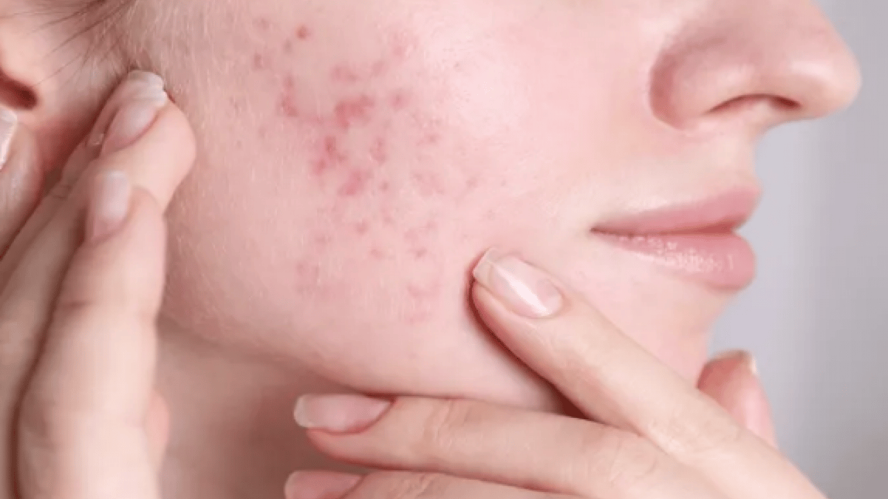 Foto - Tam bir çözüm metodu: Sivilce izlerini tek gecede siliyor! Aktarlarda kapış kapış satılıyor...