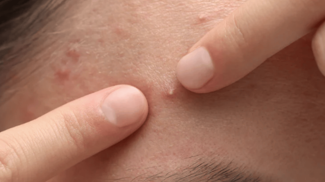 Foto - Tam bir çözüm metodu: Sivilce izlerini tek gecede siliyor! Aktarlarda kapış kapış satılıyor...