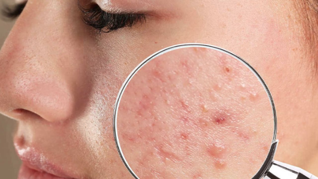 Tam bir çözüm metodu: Sivilce izlerini tek gecede siliyor! Aktarlarda kapış kapış satılıyor...