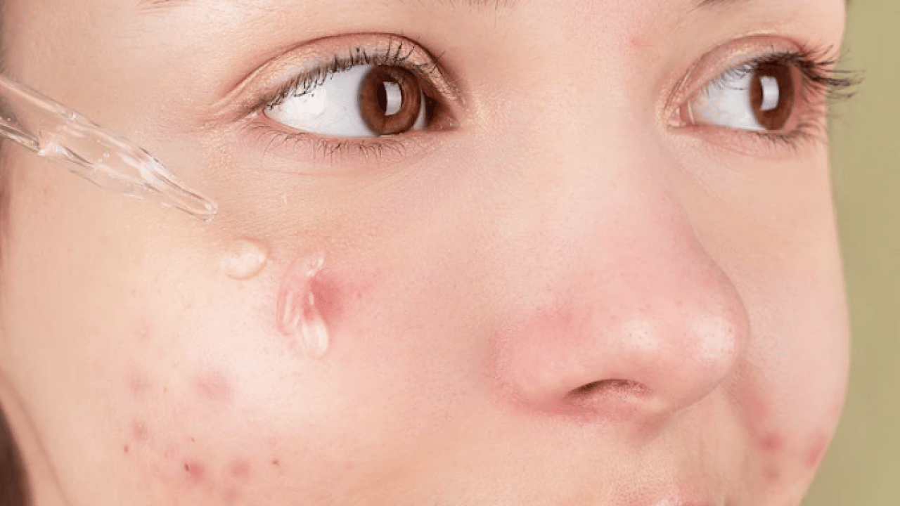 Foto - Tam bir çözüm metodu: Sivilce izlerini tek gecede siliyor! Aktarlarda kapış kapış satılıyor...