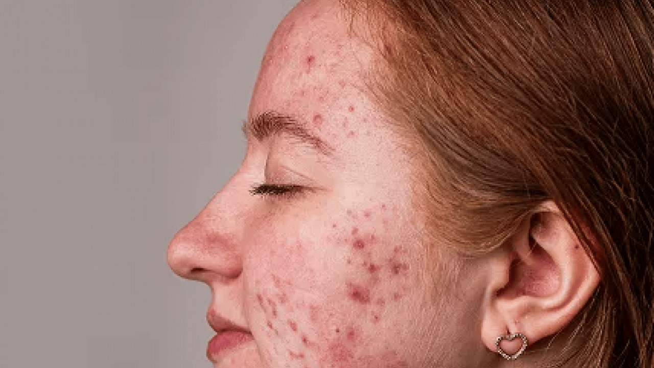 Foto - Tam bir çözüm metodu: Sivilce izlerini tek gecede siliyor! Aktarlarda kapış kapış satılıyor...