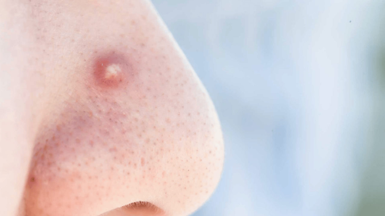 Foto - Tam bir çözüm metodu: Sivilce izlerini tek gecede siliyor! Aktarlarda kapış kapış satılıyor...