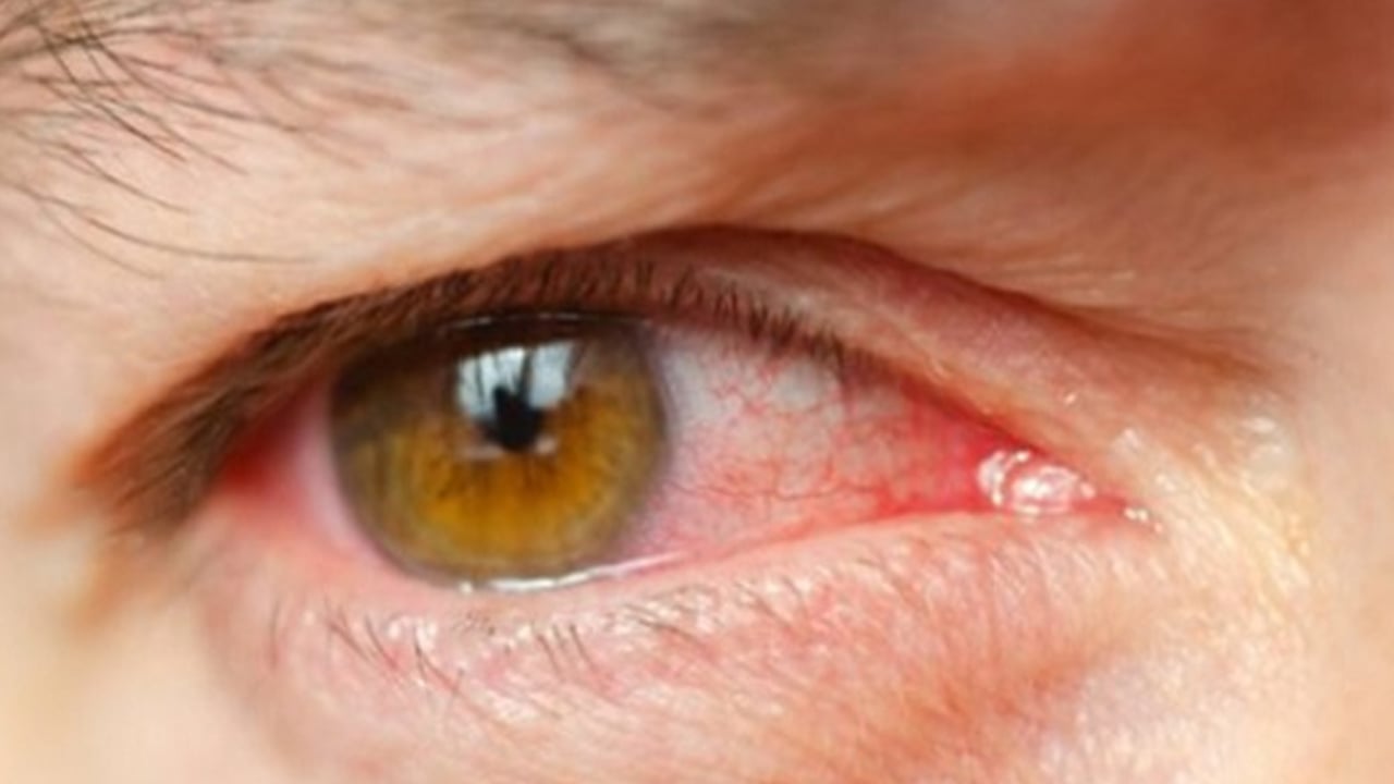 Foto - Tansiyonu bile artırıyor: Bu hastalık çok kritik, Prof. tek tek anlattı! 