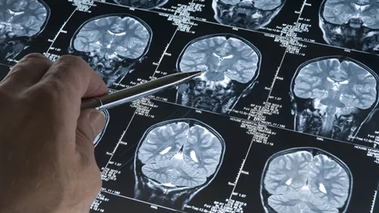 Foto - Tek başına Alzheimer’ı önleyen mucizevi bir besin: İbrahim Saraçoğlu'nun önerisi! Yeşil mucize brokoli