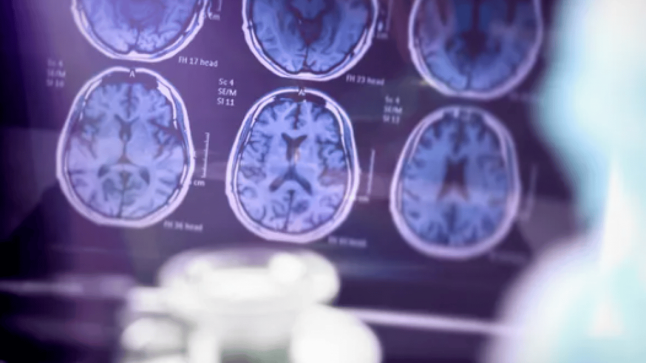 Foto - Ters köşe yapan araştırma: Alzheimer'ın ilk belirtisi unutkanlık değilmiş!