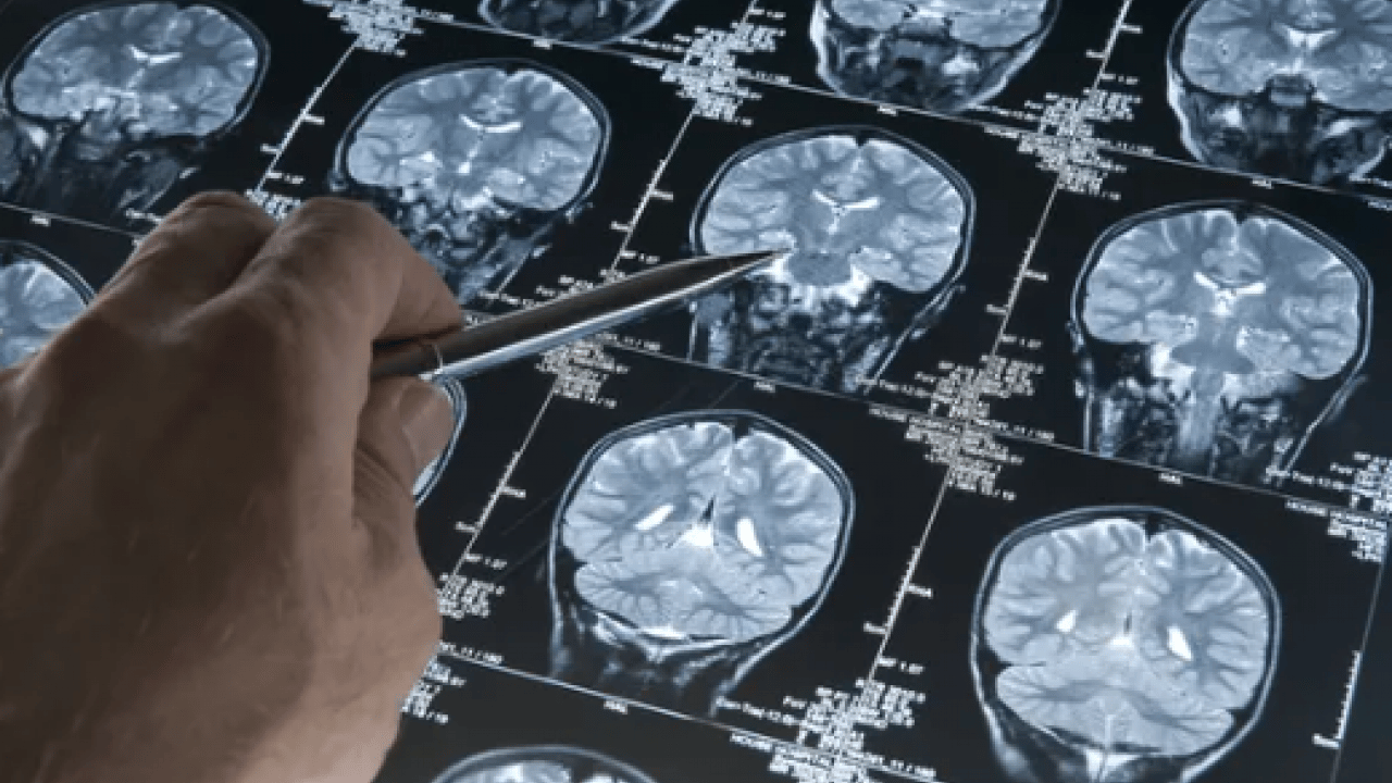 Foto - Ters köşe yapan araştırma: Alzheimer'ın ilk belirtisi unutkanlık değilmiş!