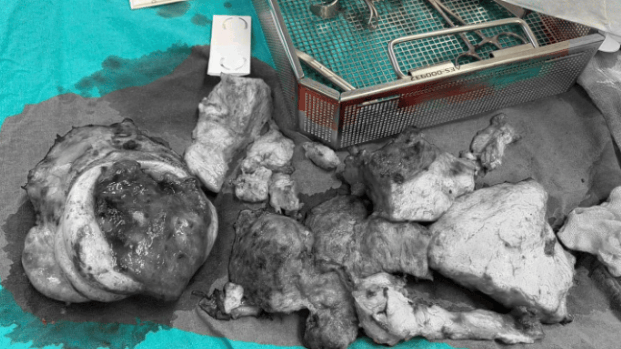 Foto - Tıp tarihine giren mucize! 10 kiloluk çocuktan 3 kiloluk tümor çıktı