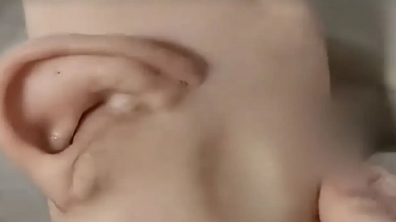 Foto - Tıpta nadir görülen uygulama: Kopan kulak geçici olarak ayağa nakledildi, aylar sonra yerine dikildi