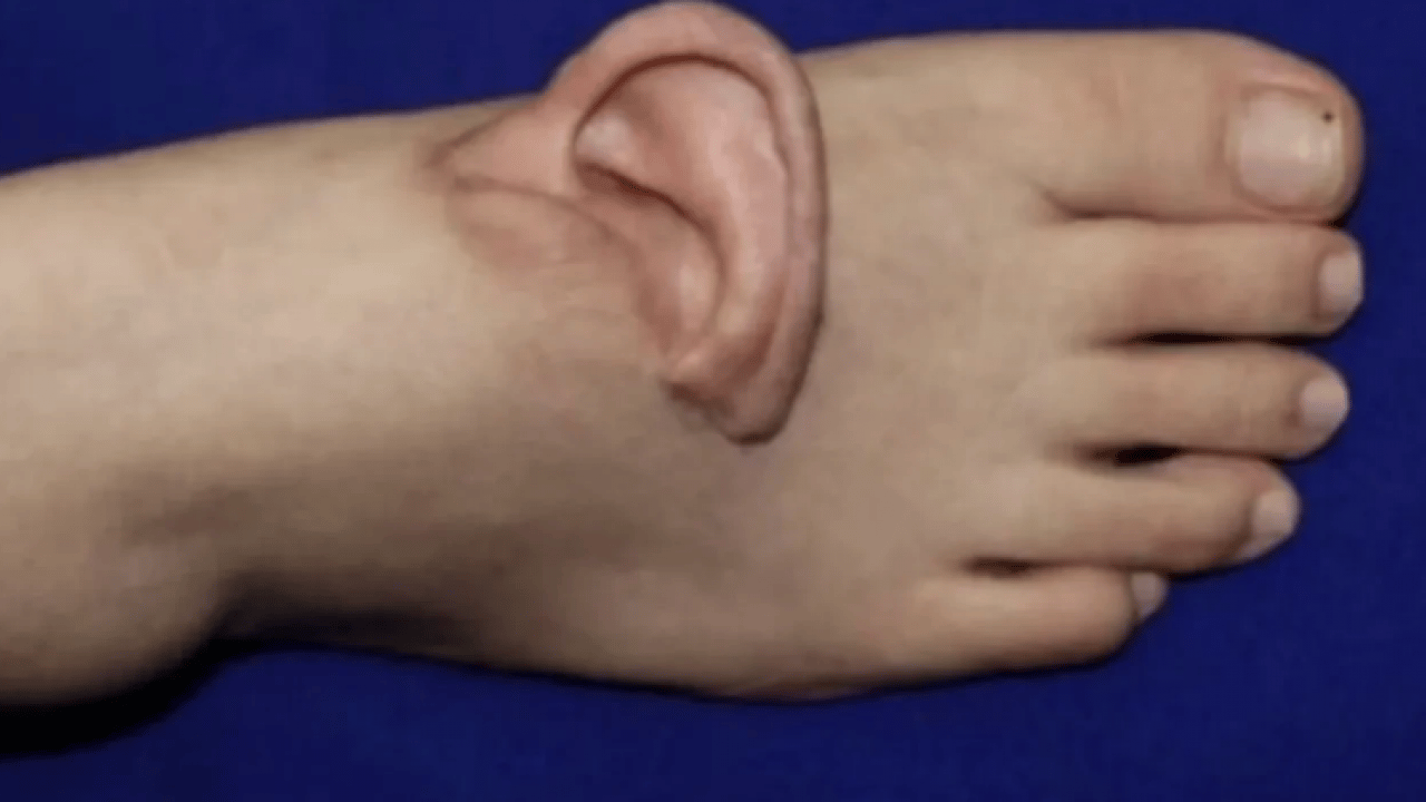 Tıpta nadir görülen uygulama: Kopan kulak geçici olarak ayağa nakledildi, aylar sonra yerine dikildi