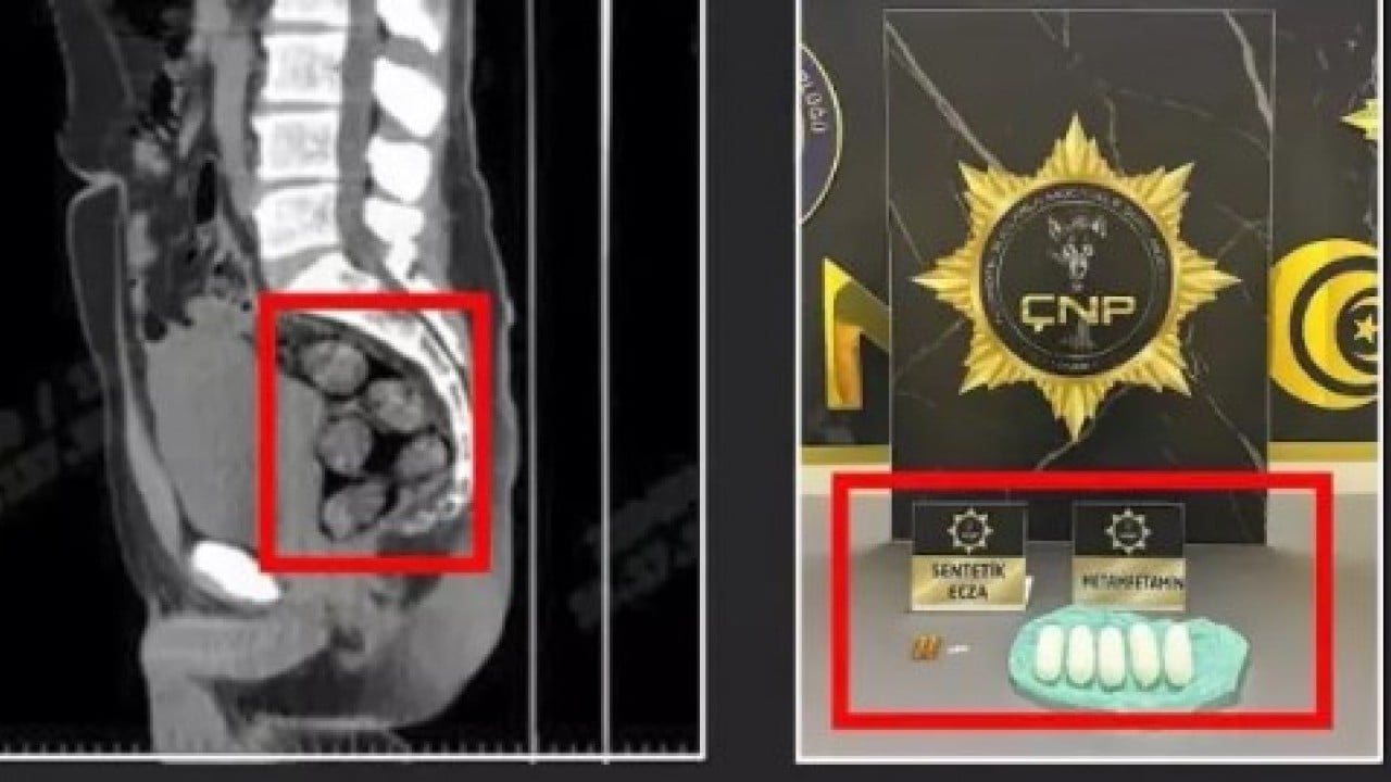 Foto - Tomografisi çekilince hapsi boyladı: Midesinden çıkanlar şok etti!