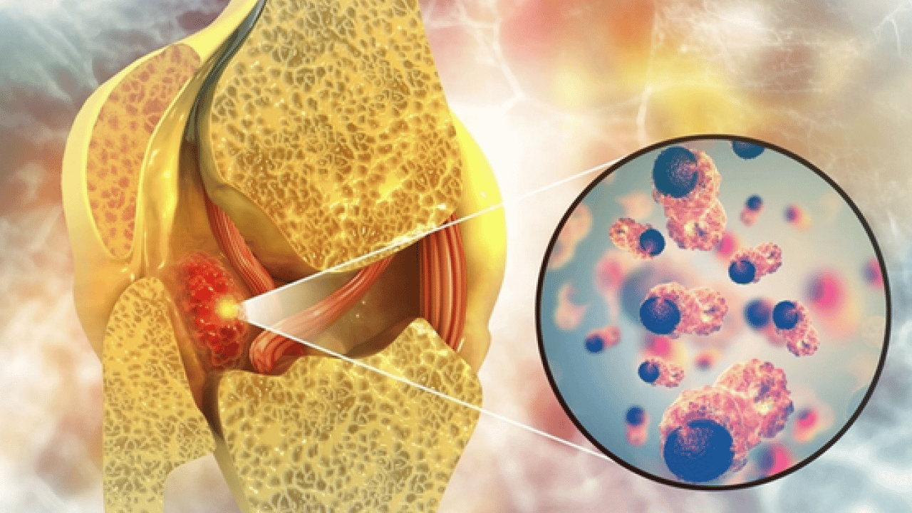 Foto - Tümör belasının önüne geçecek koruyucu cerrahi: Kemik tümörlerinde yeni dönem