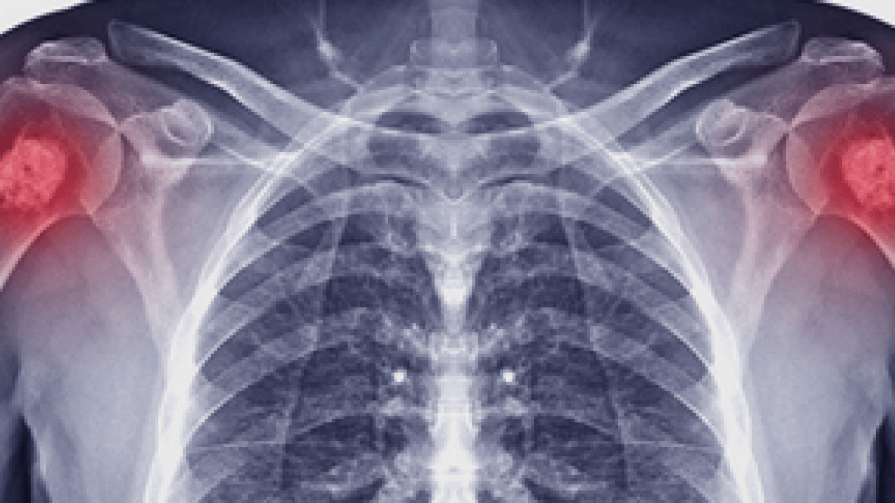 Foto - Tümör belasının önüne geçecek koruyucu cerrahi: Kemik tümörlerinde yeni dönem