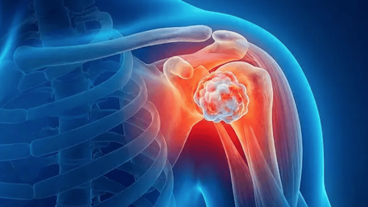 Foto - Tümör belasının önüne geçecek koruyucu cerrahi: Kemik tümörlerinde yeni dönem