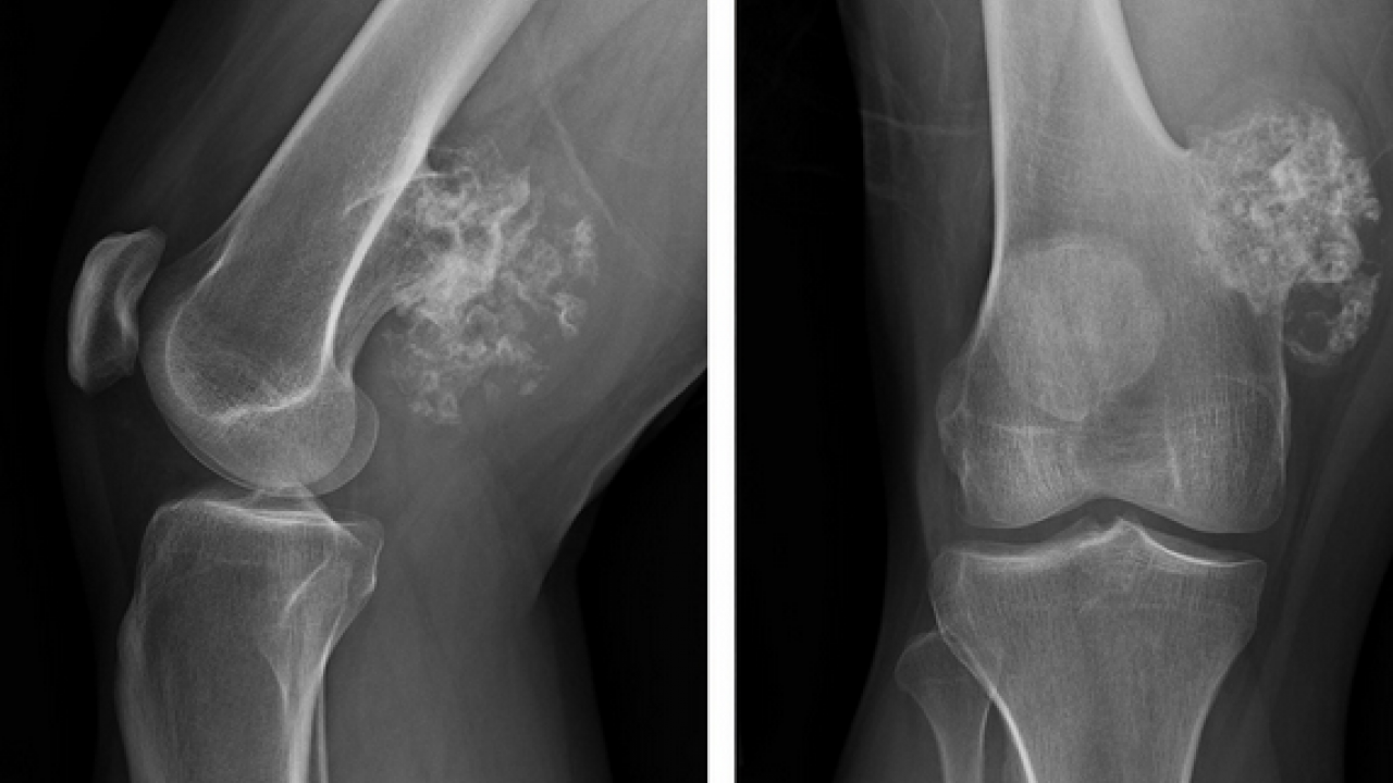 Foto - Tümör belasının önüne geçecek koruyucu cerrahi: Kemik tümörlerinde yeni dönem