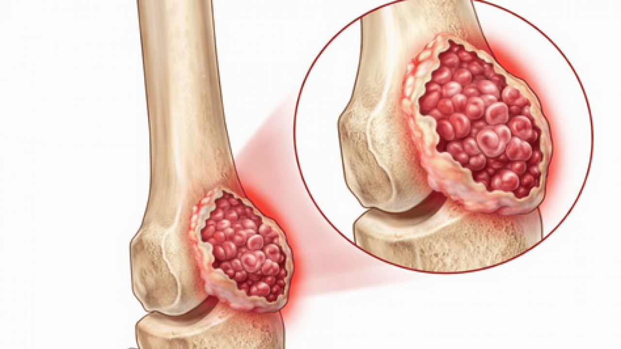 Foto - Tümör belasının önüne geçecek koruyucu cerrahi: Kemik tümörlerinde yeni dönem
