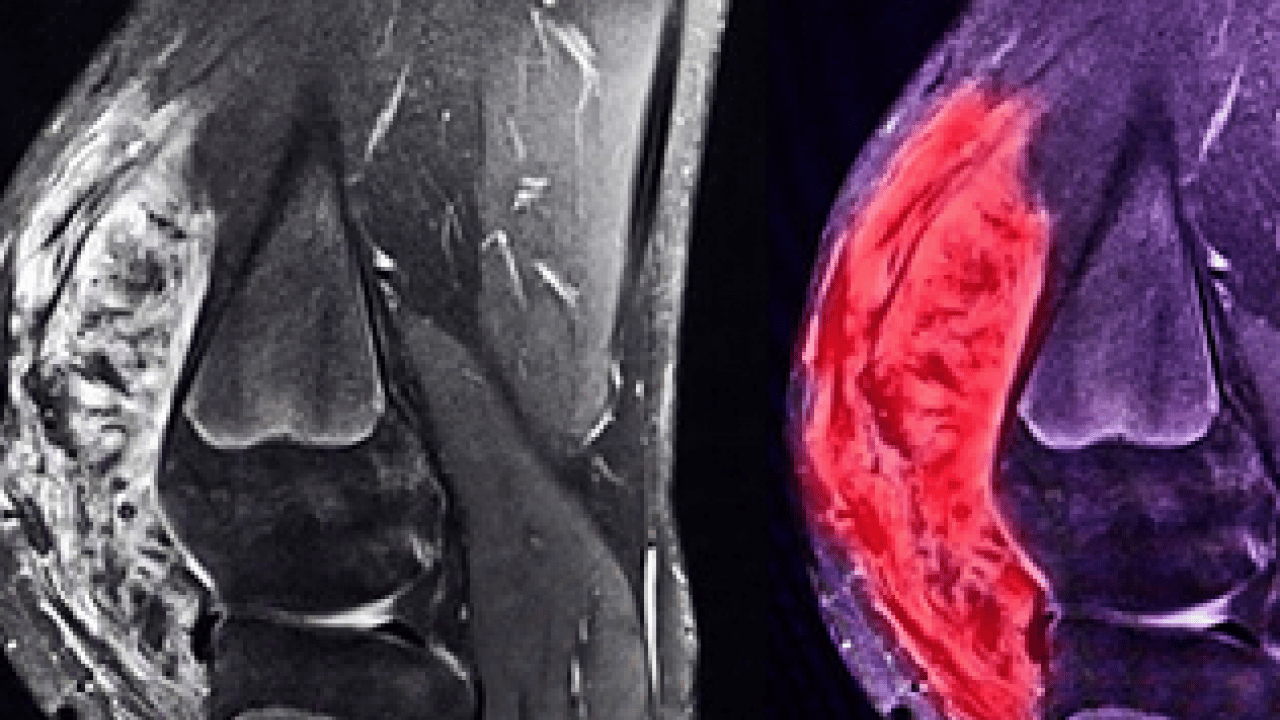 Foto - Tümör belasının önüne geçecek koruyucu cerrahi: Kemik tümörlerinde yeni dönem