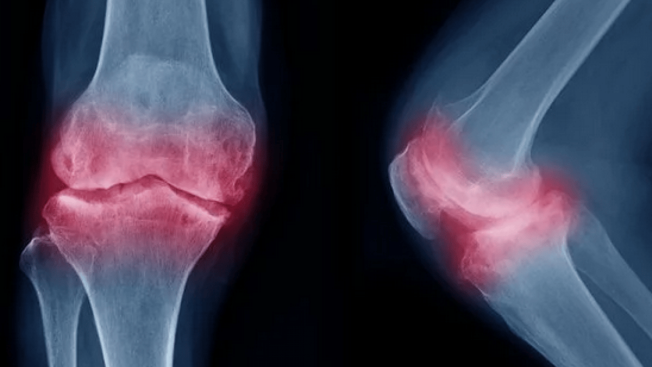 Foto - Tümör belasının önüne geçecek koruyucu cerrahi: Kemik tümörlerinde yeni dönem