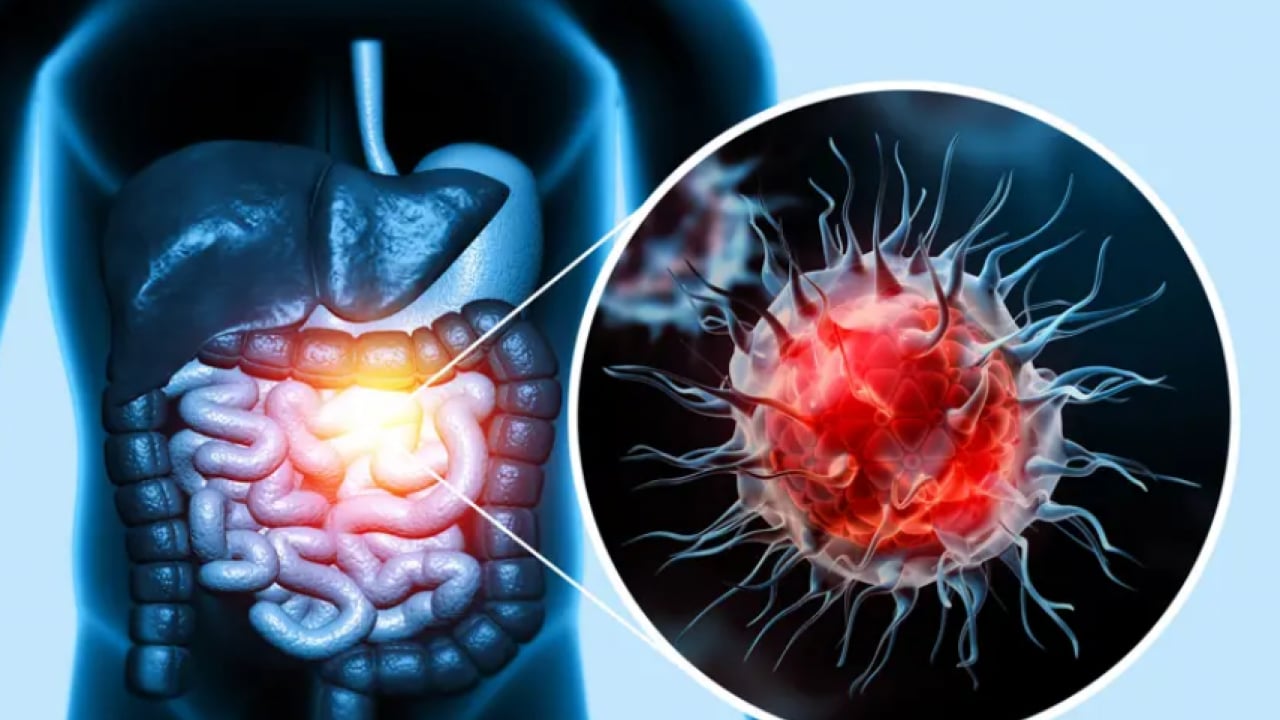 Foto - Türk bilim insanlarından çığır açan gelişme! Kolon kanserinde umut ışığı