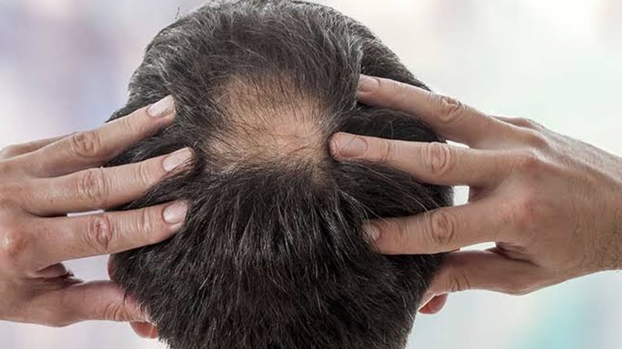 Foto - Saç bakımında iyileşeme hikayesi için önemli: D vitamini eksikliğinde güneş etkili güç!  Ayrıntılar neler ortaya çıktı