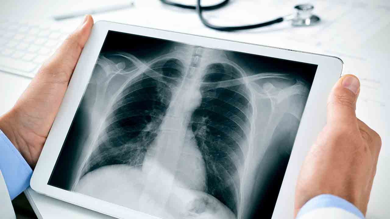Türkiye’de her yıl 40 bin kişi akciğer kanseri oluyor!