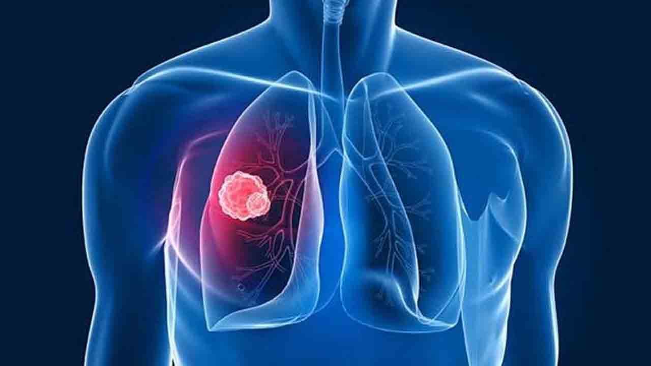Foto - Türkiye’de her yıl 40 bin kişi akciğer kanseri oluyor!