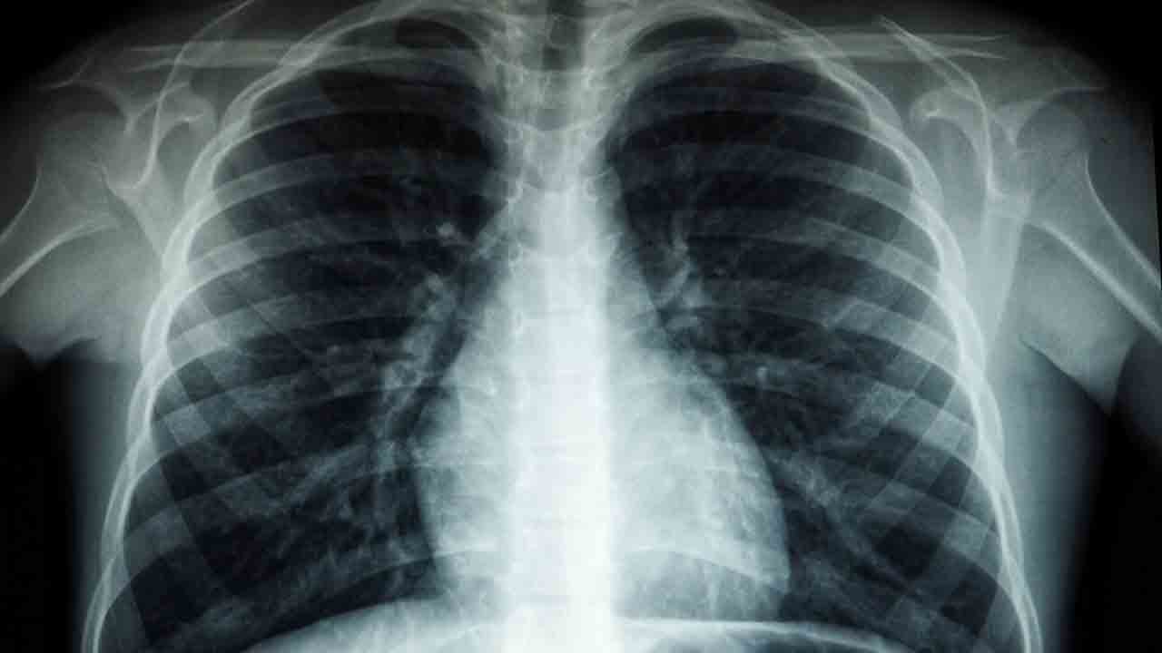 Foto - Türkiye’de her yıl 40 bin kişi akciğer kanseri oluyor!