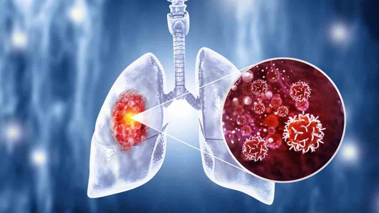 Foto - Türkiye’de her yıl 40 bin kişi akciğer kanseri oluyor!