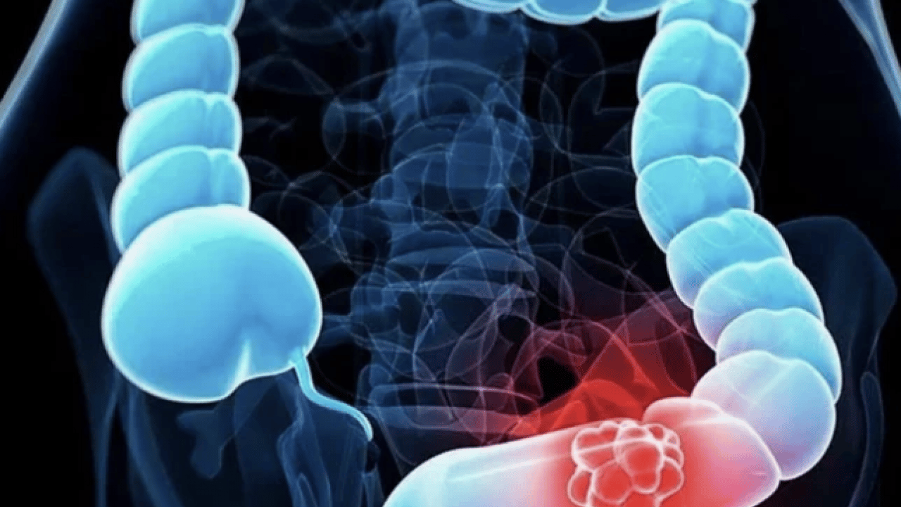 Foto - Tuvalette bu sorunu yaşıyorsanız dikkat! Bu belirti kolon kanseri habercisi olabilir... Uzmanı açıkaldı