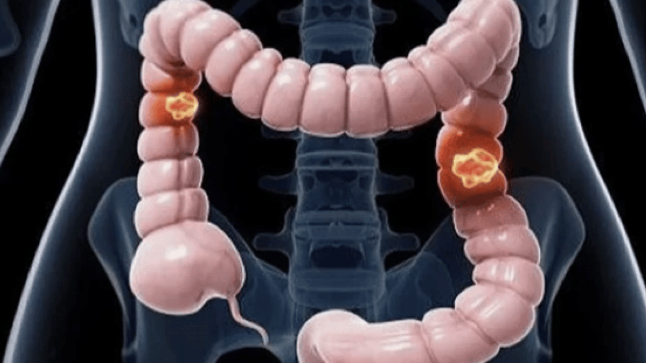 Foto - Tuvalette bu sorunu yaşıyorsanız dikkat! Bu belirti kolon kanseri habercisi olabilir... Uzmanı açıkaldı