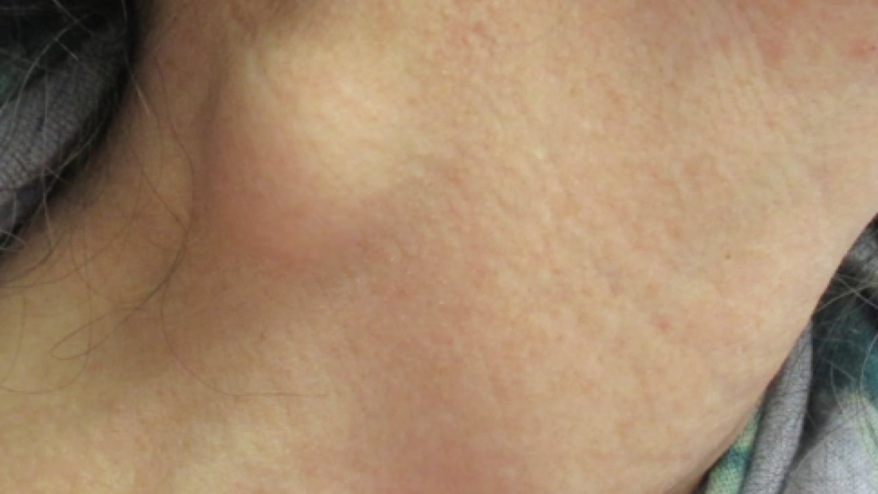 Foto - Üç haftayı geçen şikayetlere dikkat: Kanser belirtisi olabilir