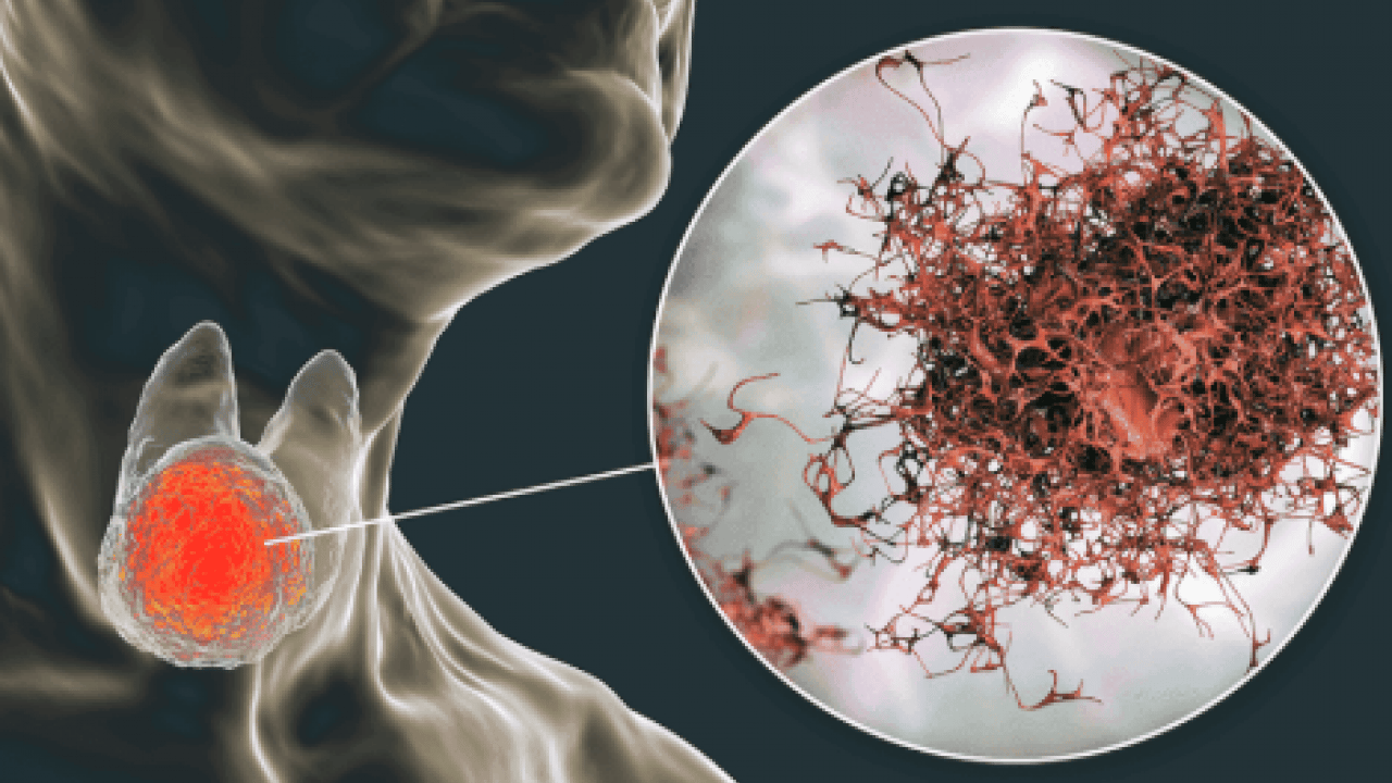Üç haftayı geçen şikayetlere dikkat: Kanser belirtisi olabilir