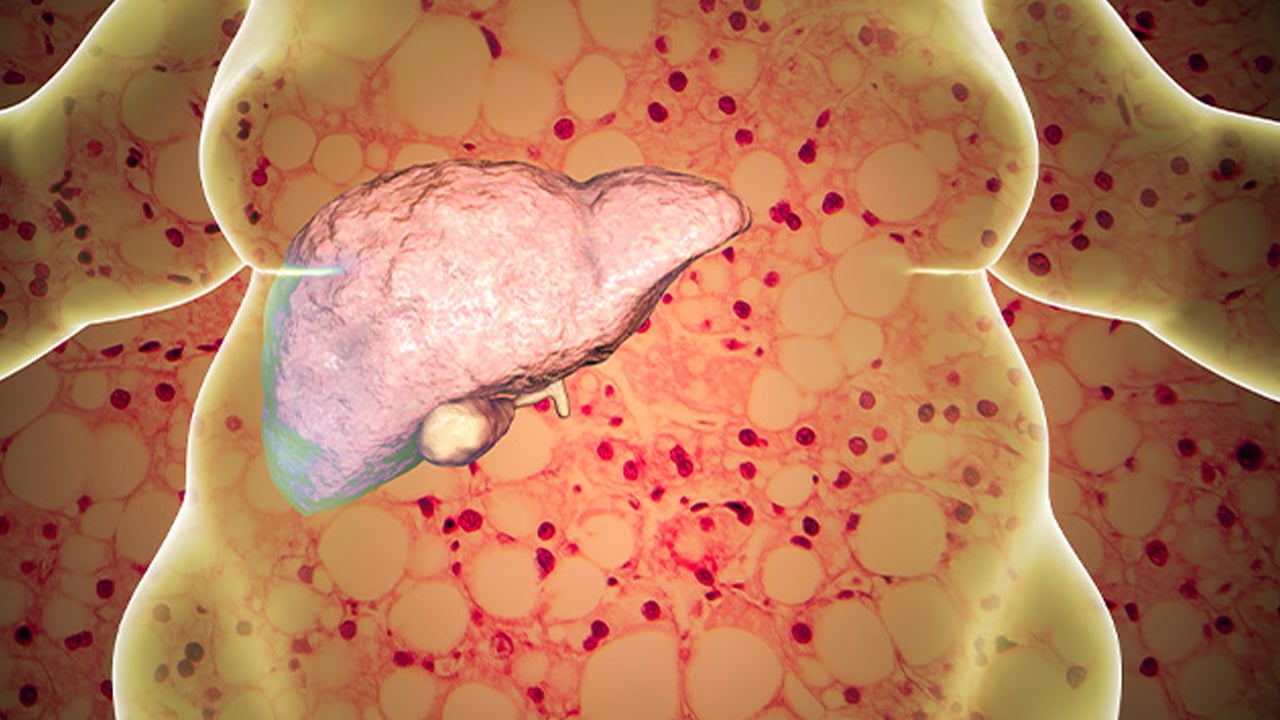 Ufuk Özkan'ın yaptığı diyet neden yanlış? 1 yıldır karaciğer yetmezliğiyle mücadele ediyordu!