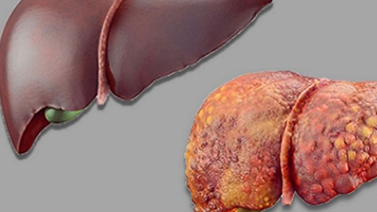 Foto - Ufuk Özkan'ın yaptığı diyet neden yanlış? 1 yıldır karaciğer yetmezliğiyle mücadele ediyordu!