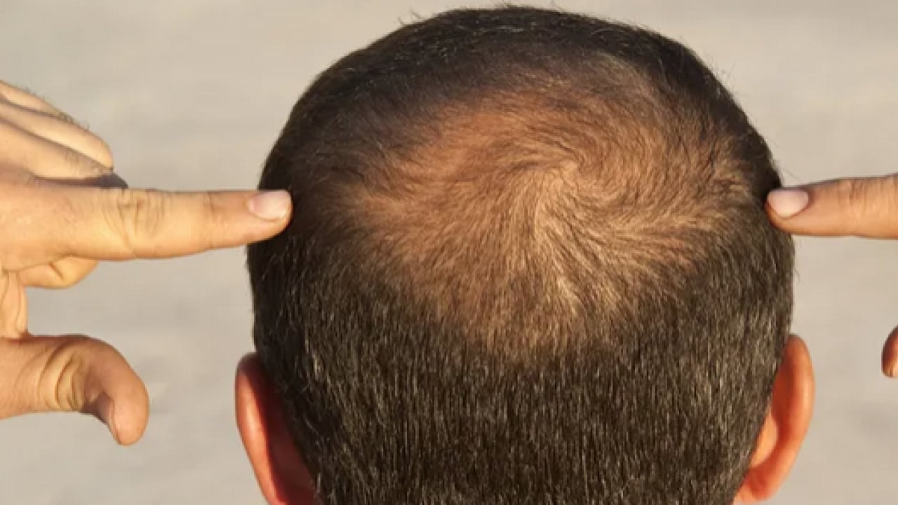 Foto - Ünlü hocadan dikkat çeken çıkış: Kelliğe çare bulundu mu? İşte saç çıkaran o şeker!