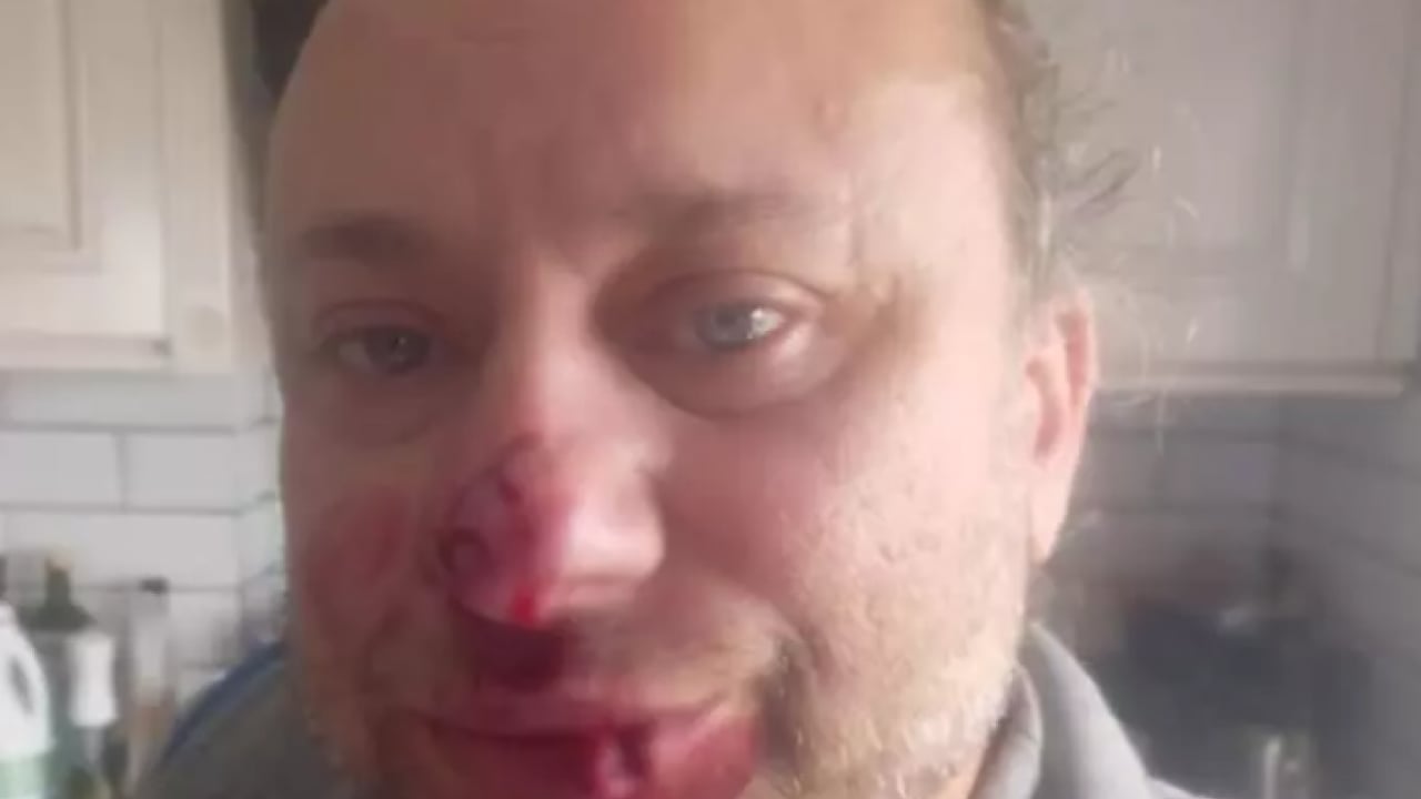 Foto - Başıboş pitbull sanatçının burnunu kopardı! Son durumunu paylaştı!