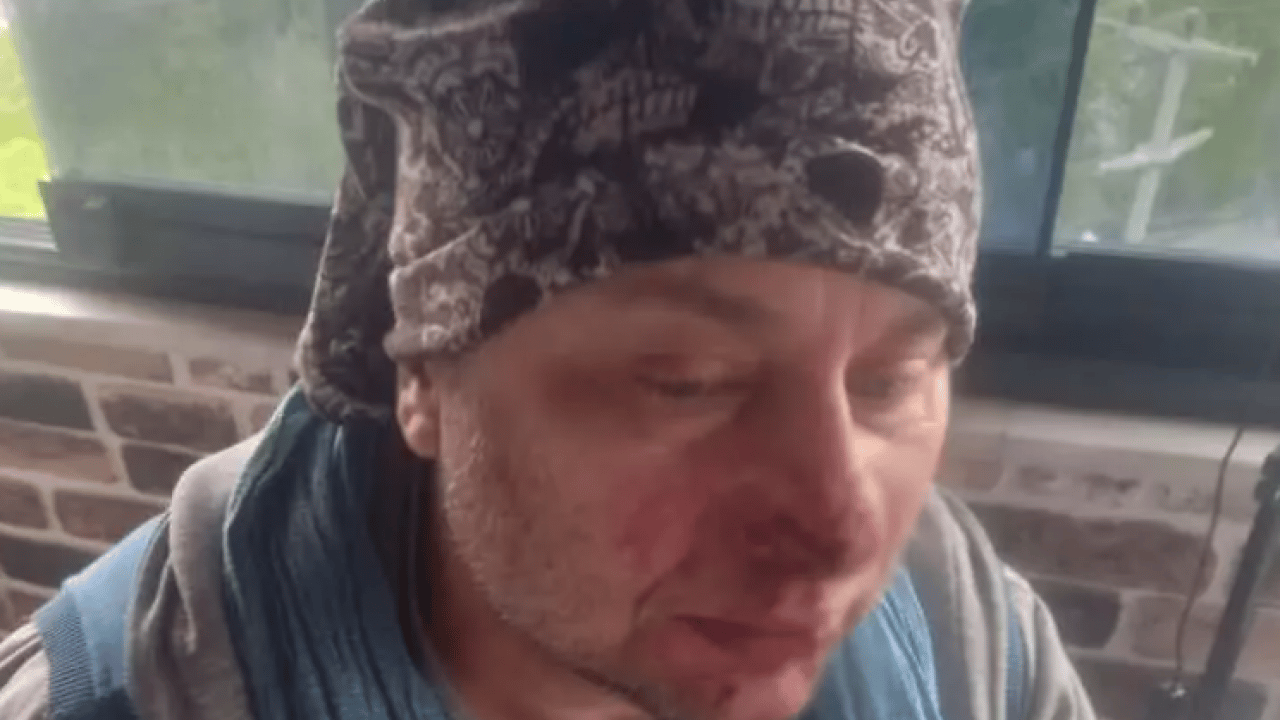 Foto - Başıboş pitbull sanatçının burnunu kopardı! Son durumunu paylaştı!